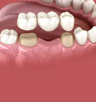 Ilustração 3D de uma arcada com um espaço de dente ausente entre os dentes vizinhos