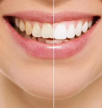 Comparação lado a lado de um sorriso antes e depois de tratamento estético