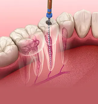 Ilustração 3D de um instrumento endodôntico dentro do canal radicular de um dente