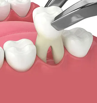 Ilustração 3D de um fórceps posicionado para a remoção de um dente