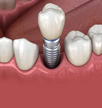 Ilustração 3D de um implante de titânio com coroa instalado entre dois dentes naturais