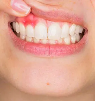 Ilustração de uma gengiva inflamada e avermelhada na região dos dentes superiores