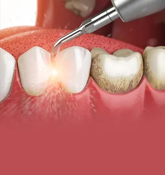 Ilustração 3D de um instrumento de limpeza removendo tártaro da superfície de um dente