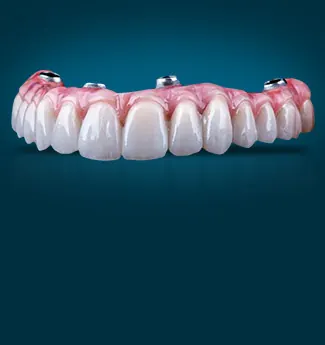 Ilustração 3D de uma prótese protocolo fixa apoiada sobre implantes em uma arcada completa